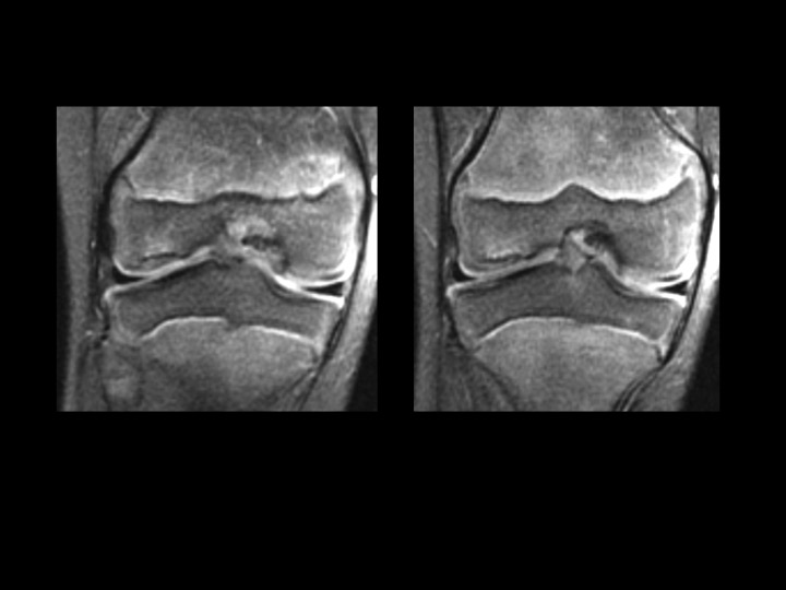 Figure 2 for case normal developmental irregular ossification lateral femoral condyle